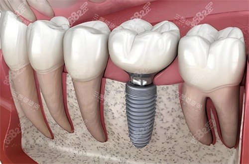 種植牙動(dòng)畫示圖 種植牙動(dòng)畫示圖