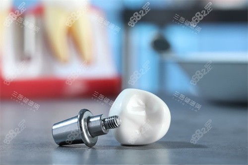 種植牙材料 種植牙材料