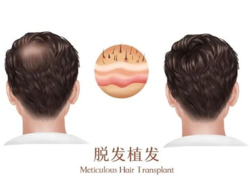 合肥植發(fā)比較靠譜的醫(yī)院