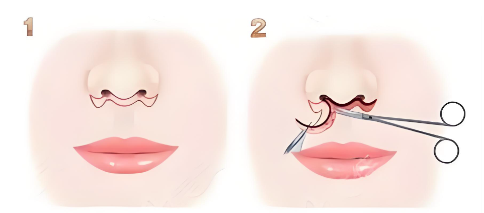 張賀醫(yī)生人中縮短手術(shù)預(yù)約掛號(hào)