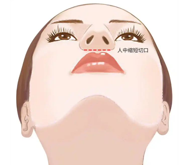 上海張賀醫(yī)生人中縮短手術(shù)