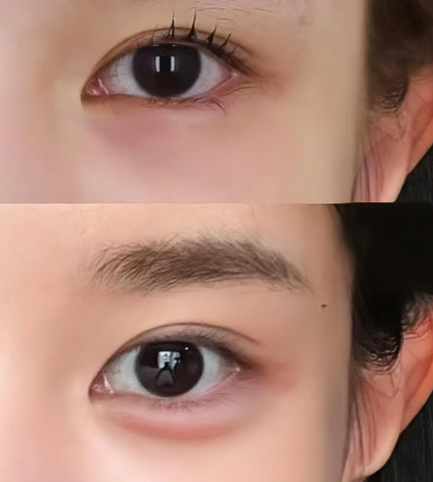 腰腹脂肪填充臥蠶的療效為什么自然持久