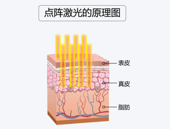點(diǎn)陣激光祛斑療效體現(xiàn)