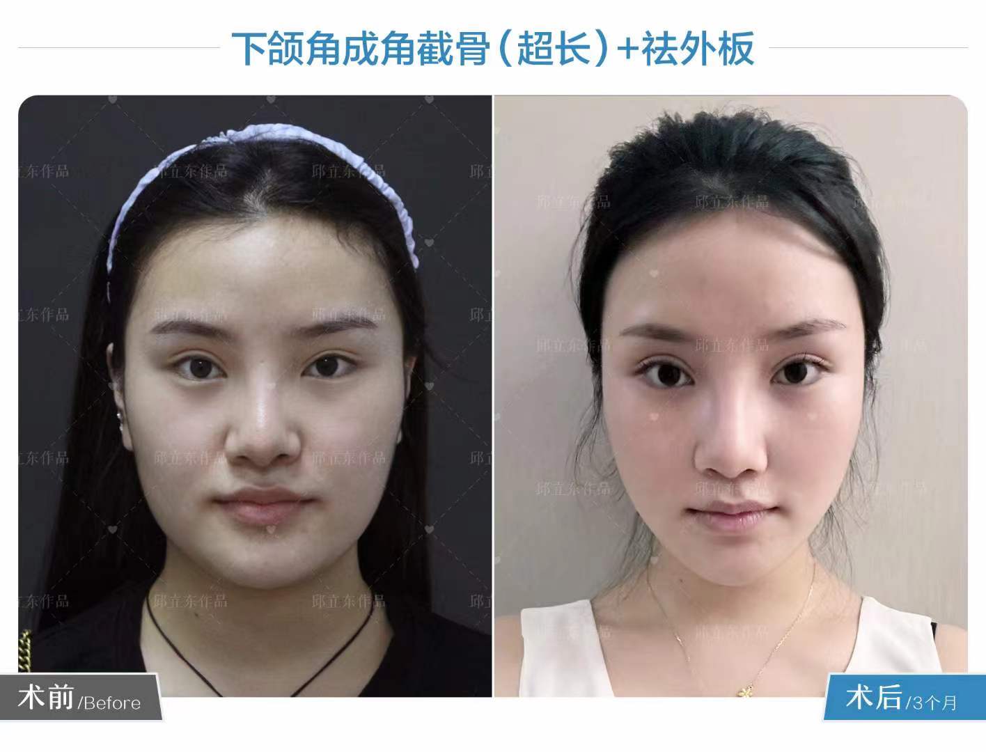 如何改善臉型邱立東效果好不好？