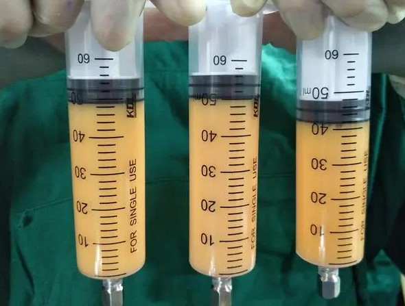 腰腹抽脂填充臥蠶的關(guān)鍵注意事項(xiàng)