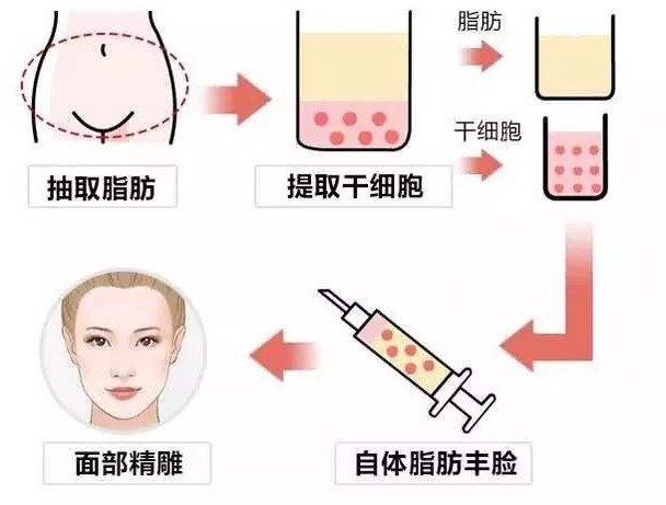 腰腹抽脂填充臥蠶