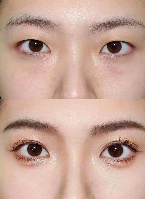 三、王維醫(yī)生雙眼皮多少錢