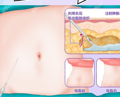 福州吸脂比較出名的醫(yī)生