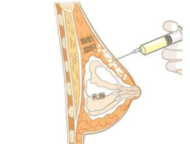 佐蘭雅iba極速豐胸技術(shù)介紹