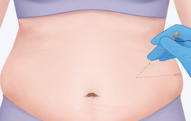福州埋線減肥注意事項