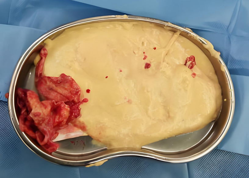 奧美定取出后乳房塌陷