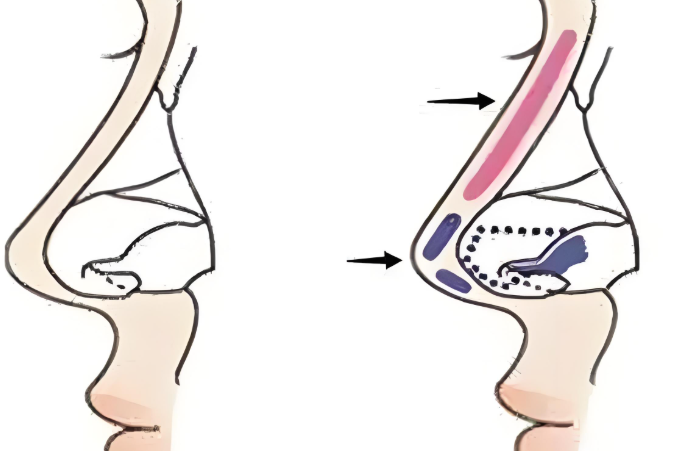 武漢鼻部整形醫(yī)生吳茂源技術(shù)特色
