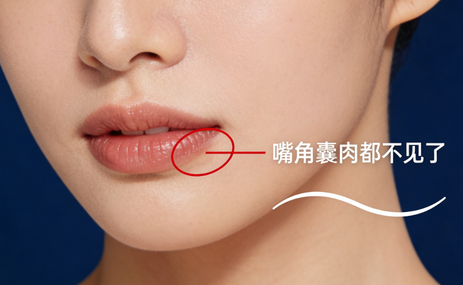 阮正泉筋膜懸吊提升做的好