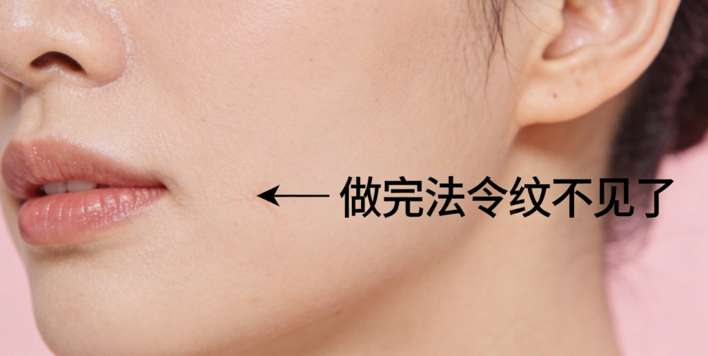 阮正泉筋膜懸吊提升改善法令紋好