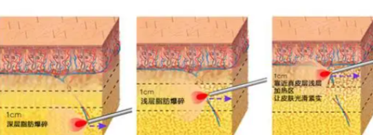 闊遠和孟繁瑾醫(yī)生哪個溶脂好？風(fēng)格對比解析