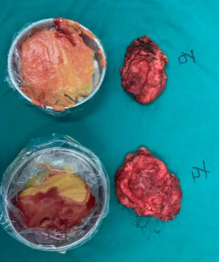 奧美定豐胸多年后有硬塊取出困難怎么辦