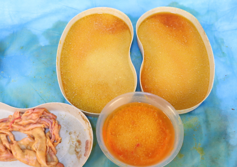 奧美定豐胸多年后有硬塊怎么取出