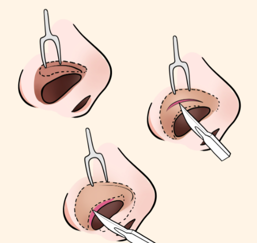 高順福醫(yī)生做鼻子就診指南
