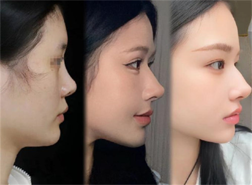 國(guó)內(nèi)頂級(jí)脂肪填充專家有誰(shuí)？王明利等技術(shù)優(yōu)案例多口碑好 