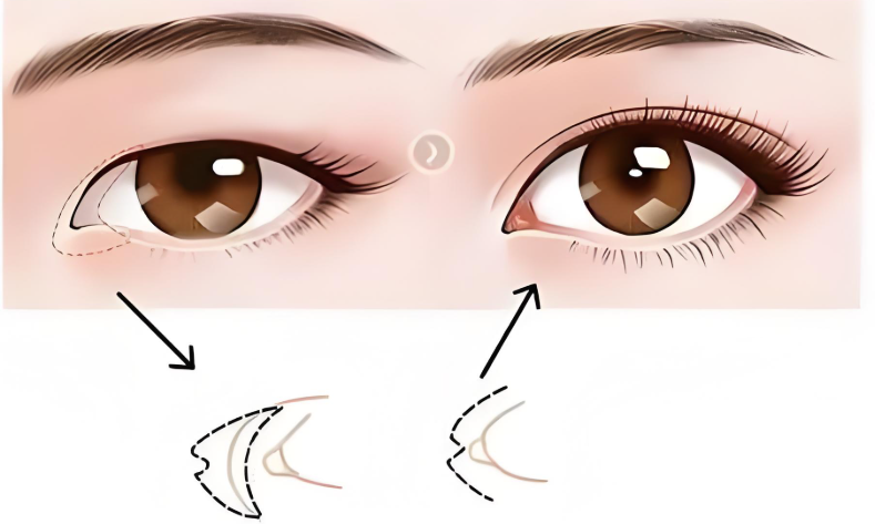 選擇臥蠶整形機(jī)構(gòu)的建議