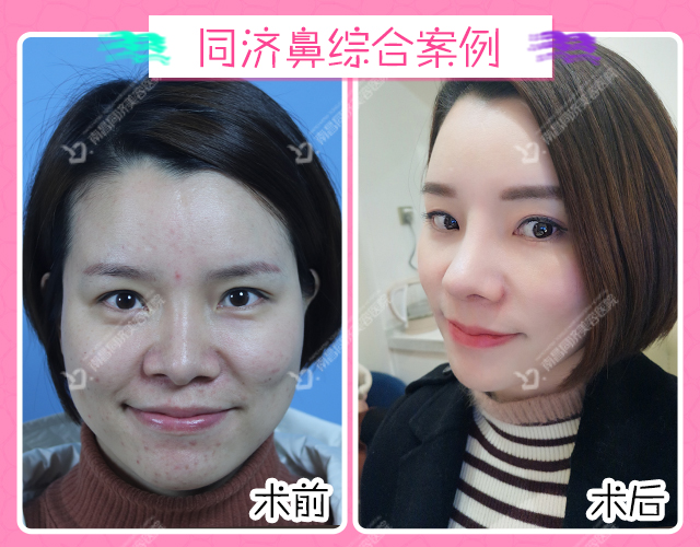 二、關于張承武全肋鼻綜合的收費明細