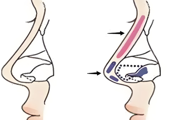 鐘惠光醫(yī)生隆鼻技術(shù)特點(diǎn)
