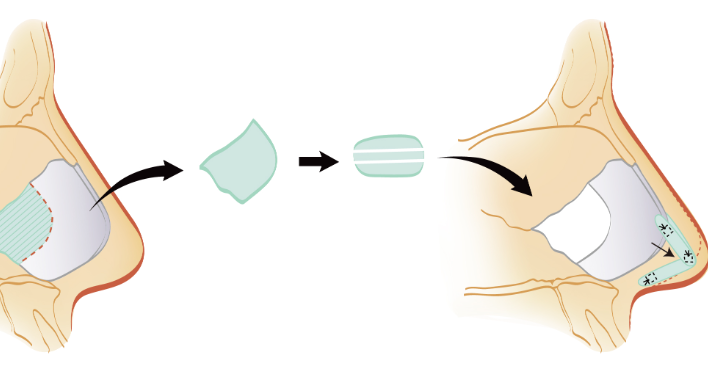 鐘惠光醫(yī)生隆鼻成功實(shí)例