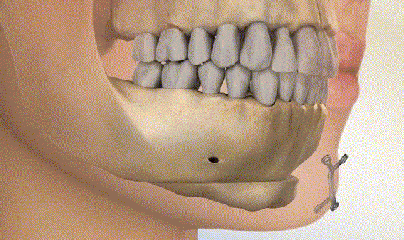 頦成型4毫米和6毫米的差距之療效方面