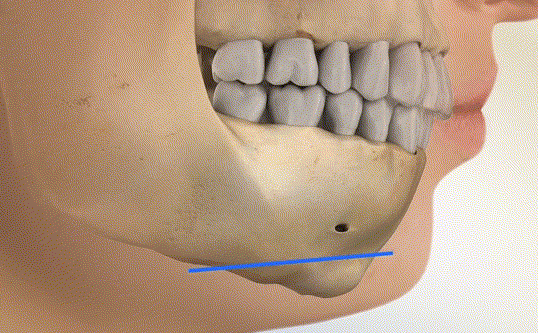 頦成型4毫米和6毫米的差距之變好情況