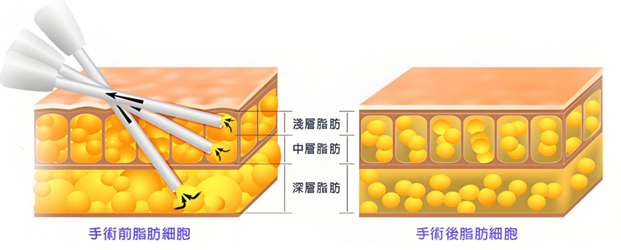 鄭州麗天整形熱門項(xiàng)目療效與性價(jià)比如何