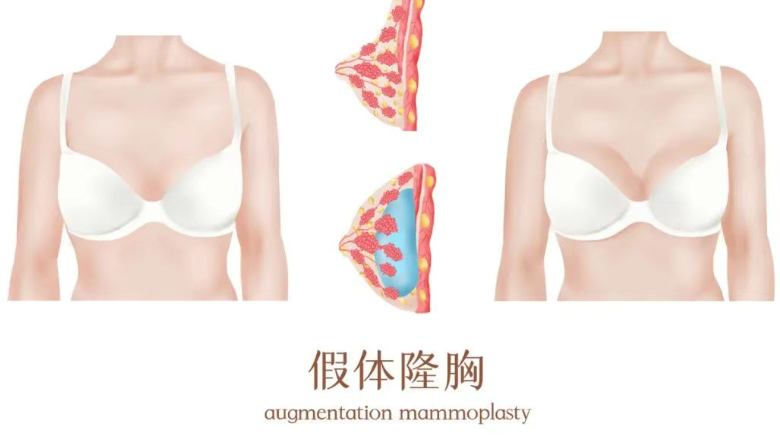 三、液態(tài)隆胸的原理是什么？可靠性問題分析