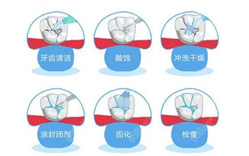 窩溝封閉的過程 窩溝封閉的過程