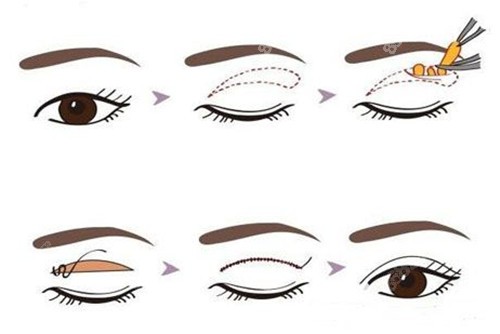 切開法眼部整形示意圖