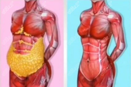 腹部脂肪消除卡通圖