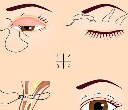 北京埋線雙眼皮排名靠前醫(yī)院總覽