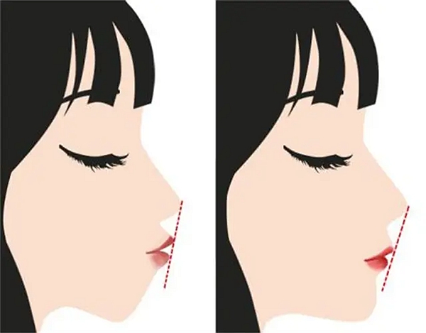 武漢萬啟龍和吳中興哪個(gè)做正頜手術(shù)好？萬啟龍擅長(zhǎng)正畸正頜聯(lián)合治療，技術(shù)更全面