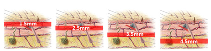 對(duì)比多種臉部提升緊致方法