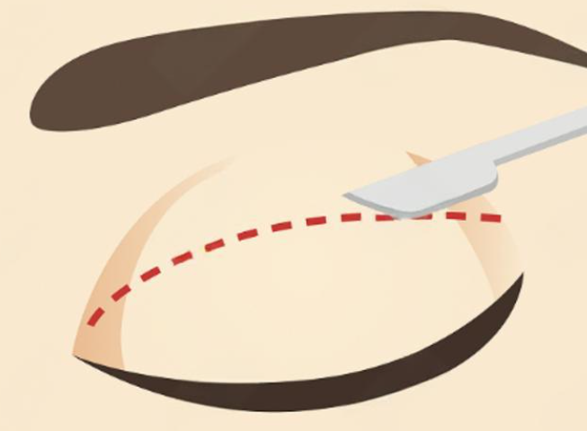 上海楊海平和張楚哪個修復雙眼皮好？