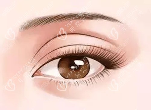 雙眼皮修復卡通示意圖