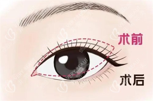 雙眼皮修復手術對比