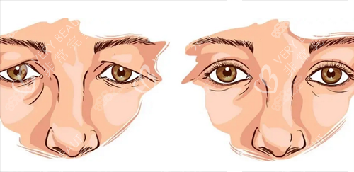 雙眼皮修復前后