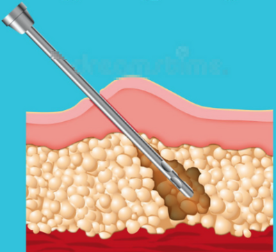 劉圓醫(yī)生的吸脂
