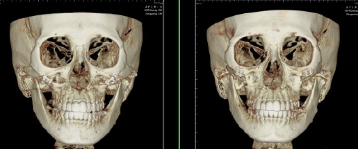 韓國(guó)老吳推顴骨