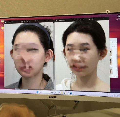 韓國(guó)老吳推顴骨