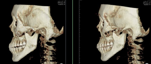 韓國(guó)老吳推顴骨費(fèi)用