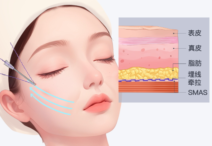 上海蘋果肌部位饅化修復(fù)醫(yī)生選擇建議