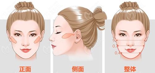 為什么顴骨修復比初做磨骨更難