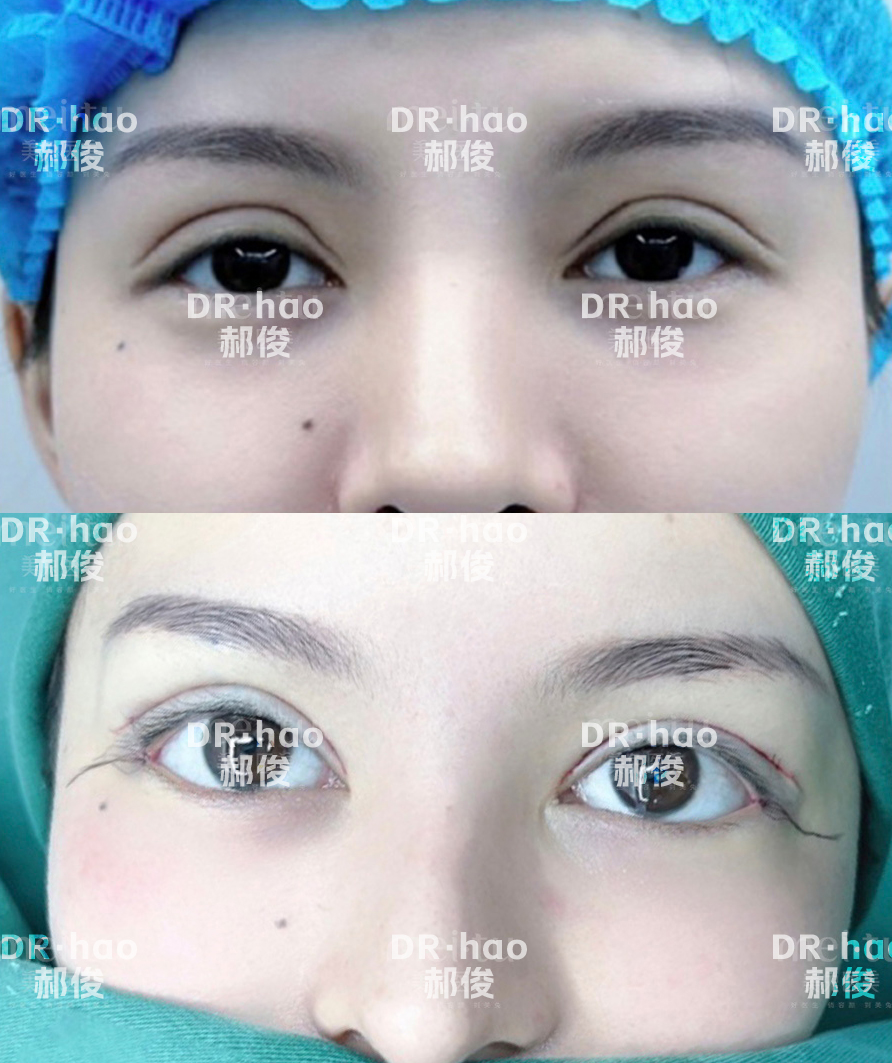 鄭州東方賀潔修復(fù)雙眼皮預(yù)約及注意事項(xiàng)？