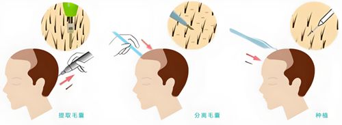 五、判斷和治療M型發(fā)際線有哪些注意事項？