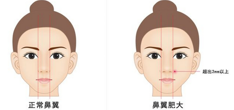 二、張承武醫(yī)生鼻整形手術(shù)技術(shù)成熟穩(wěn)定：專有加持 + 精細(xì)化操作，從根源降低返修